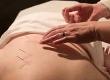 Acupuncture and Stress